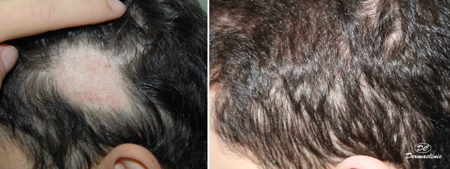 Alopecia Areata Dermaclinic