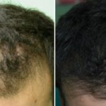 alopecia androgenica logroño