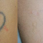 Laser para tatuajes Dermaclinic