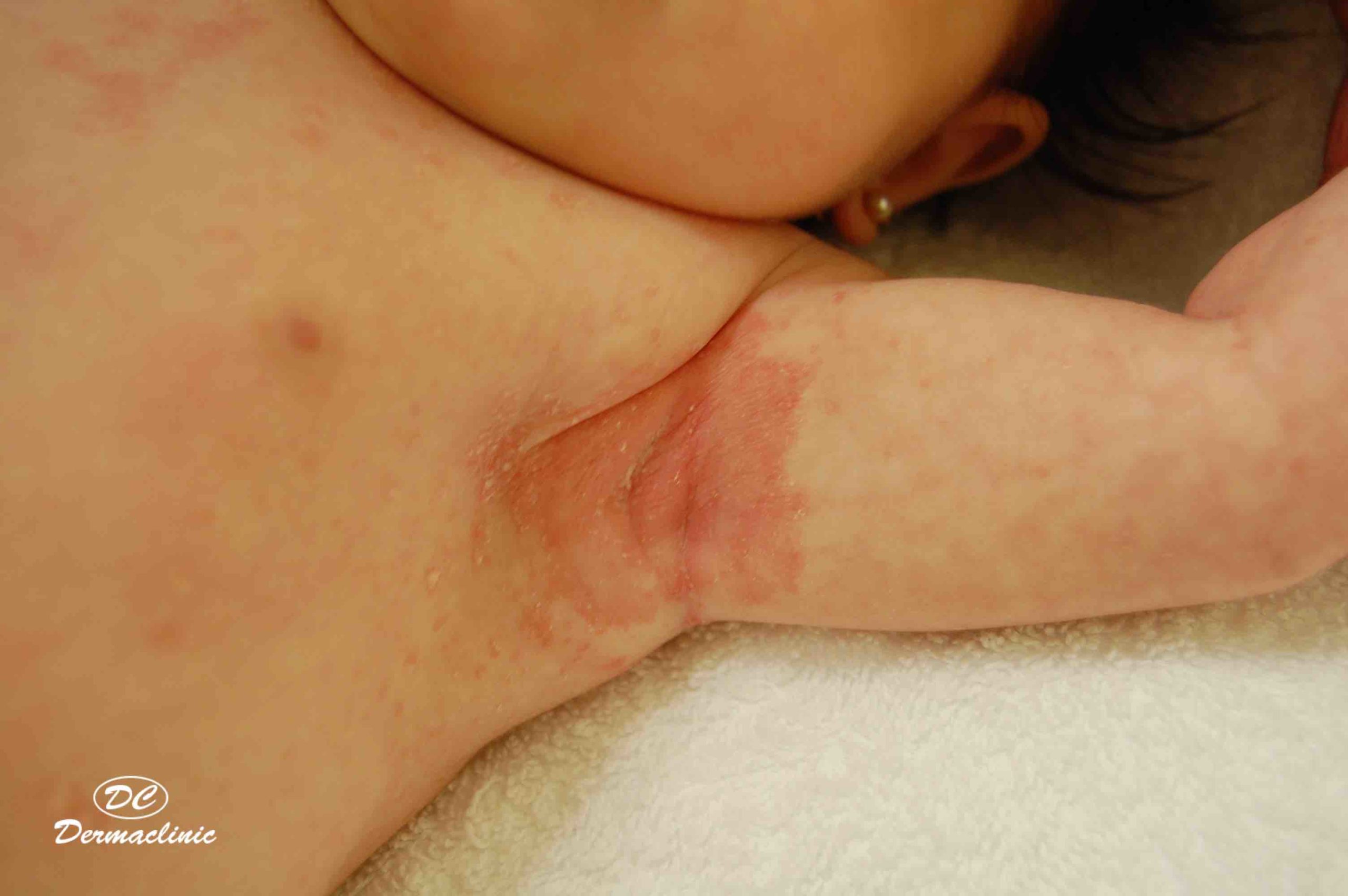 Dermatitis seborreica - Dermaclinic