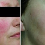 Tratamiento del enrojecimiento facial en Dermaclinic