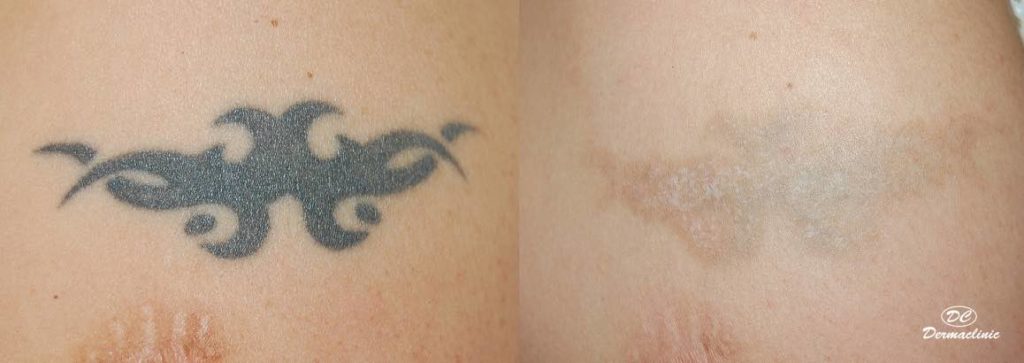 Laser para tatuajes Dermaclinic