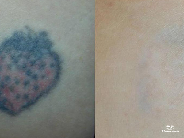 Láser para tatuajes dermaclinic