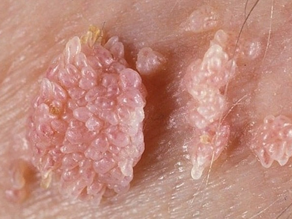 Verruga papiloma virus- Dermaclinic