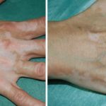 vitiligo dermatologo logroño